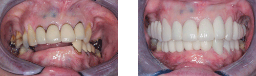 before and after image of teeth