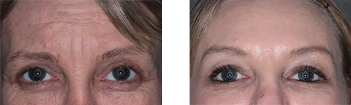 before and after image of eyes
