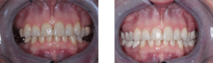 before and after image of teeth