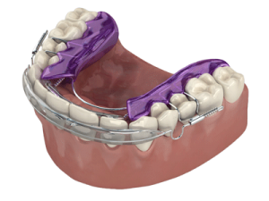 orthodontics inman aligner