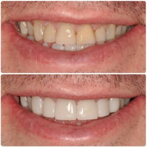 composite bonding before and after image dentist on the rock