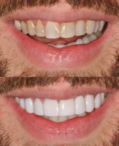 composite bonding before and after image dentist on the rock